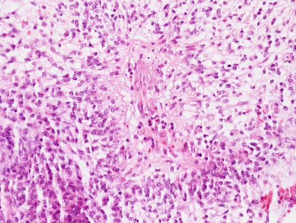 4B1 Astrocytoma, pilomyxoid (Case 4) H&E 2.jpg