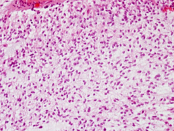 4B2 Astrocytoma, pilomyxoid (Case 4) H&E 8.jpg