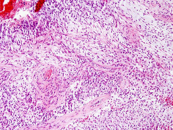 4B3 Astrocytoma, pilomyxoid (Case 4) H&E 6.jpg