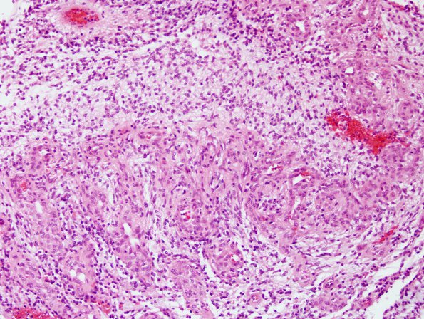 4B4 Astrocytoma, pilomyxoid (Case 4) H&E 11.jpg