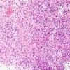 4B5 Astrocytoma, pilomyxoid (Case 4) H&E 13.jpg