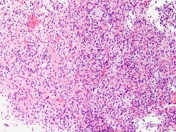 4B5 Astrocytoma, pilomyxoid (Case 4) H&E 13.jpg