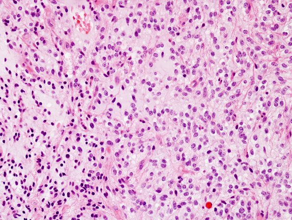 4B6 Astrocytoma, pilomyxoid (Case 4) H&E 12.jpg