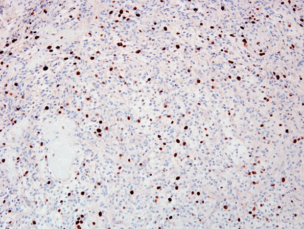 4D Astrocytoma, pilomyxoid (Case 4) Ki67 1.jpg