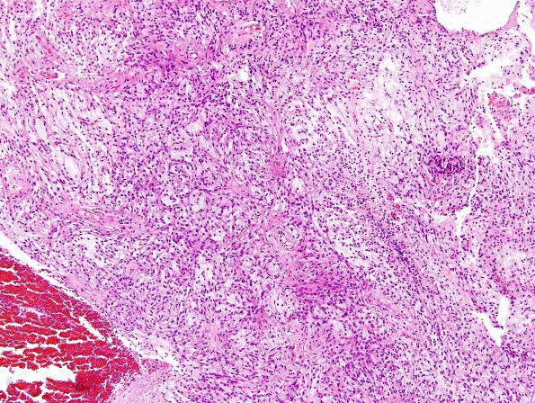 5A1 Astrocytoma, pilocytic with pilomyxoid features (Case 5) H&E 7.jpg