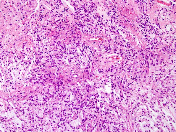 5A2 Astrocytoma, pilocytic with pilomyxoid features (Case 5) H&E 6.jpg