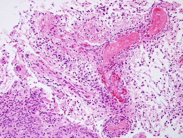 5A3 Astrocytoma, pilocytic with pilomyxoid features (Case 5) H&E 1.jpg