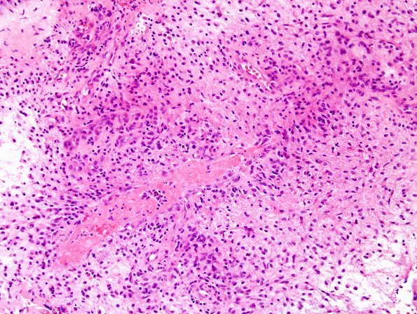 5A4 Astrocytoma, pilocytic with pilomyxoid features (Case 5) H&E 3.jpg