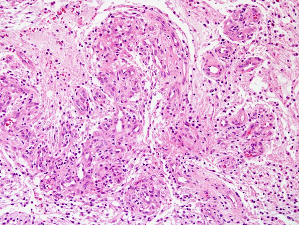 5A5 Astrocytoma, pilocytic with pilomyxoid features (Case 5) H&E 9.jpg