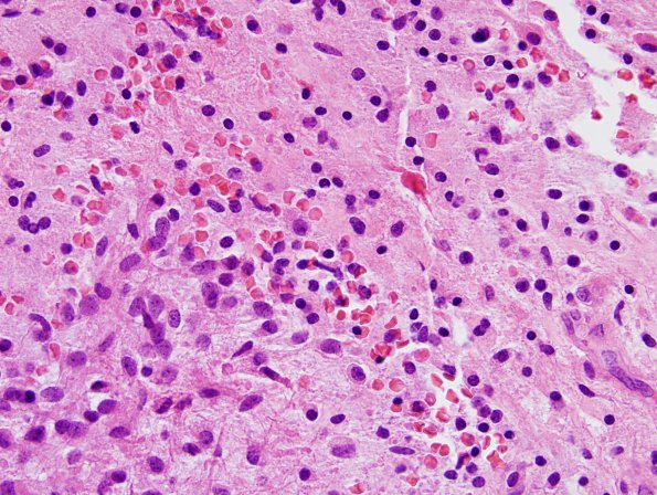 5A6 Astrocytoma, pilocytic with pilomyxoid features (Case 5) H&E 8.jpg