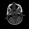 6A1 Astrocytoma, pilomyxoid & PA (Case 6) MRI-FLAIR