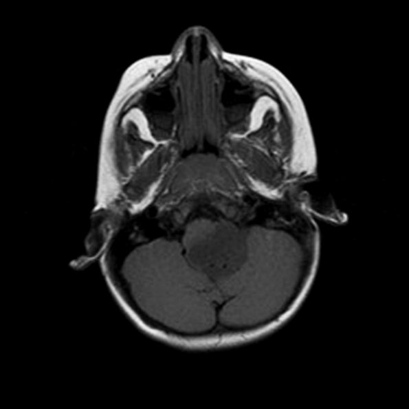 6A1 Astrocytoma, pilomyxoid & PA (Case 6) MRI-FLAIR