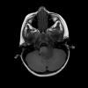 6A 2 Astrocytoma, pilomyxoid & PA (Case 6) MRI-T1