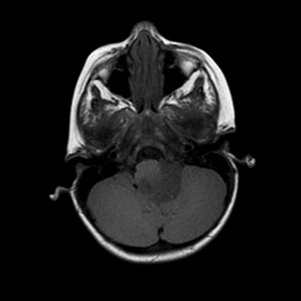 6A 2 Astrocytoma, pilomyxoid & PA (Case 6) MRI-T1