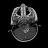 6A3 Astrocytoma, pilomyxoid & PA (Case 6) MRI T1 with Contrast