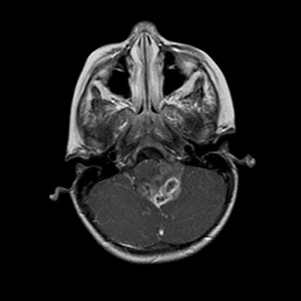 6A3 Astrocytoma, pilomyxoid & PA (Case 6) MRI T1 with Contrast