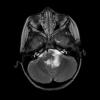 6A4 Astrocytoma, pilomyxoid & PA (Case 6) MRI-T2