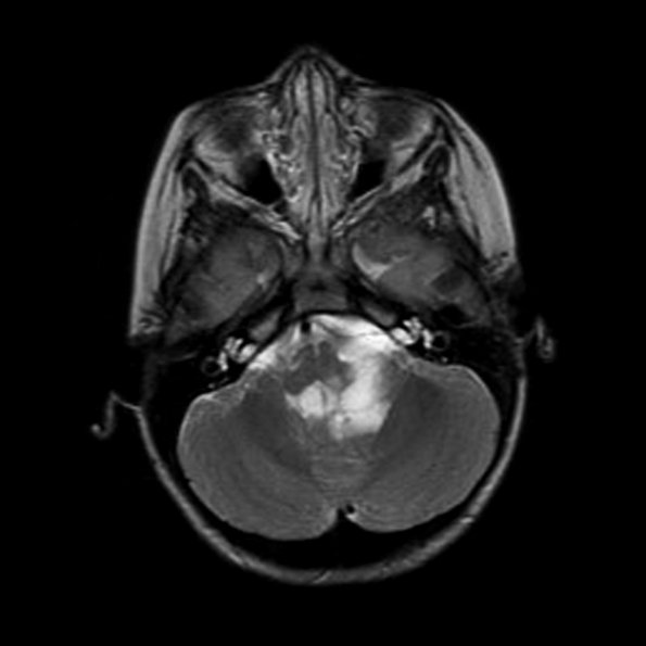 6A4 Astrocytoma, pilomyxoid & PA (Case 6) MRI-T2