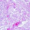 6B1 Astrocytoma, pilomyxoid & PA (Case 6) 1.jpg