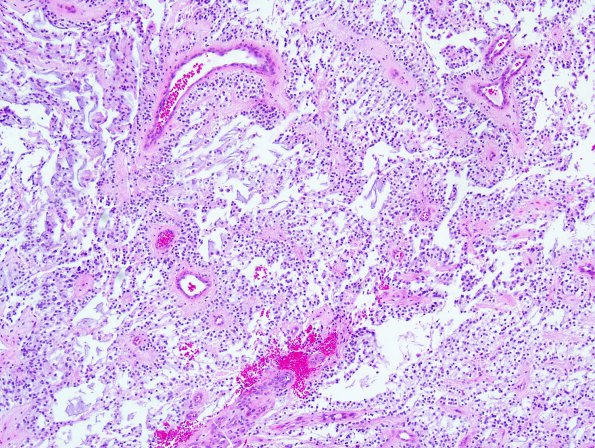 6B1 Astrocytoma, pilomyxoid & PA (Case 6) 1.jpg