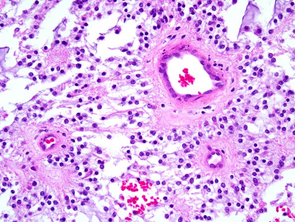 6B2 Astrocytoma, pilomyxoid & PA (Case 6) 3.jpg