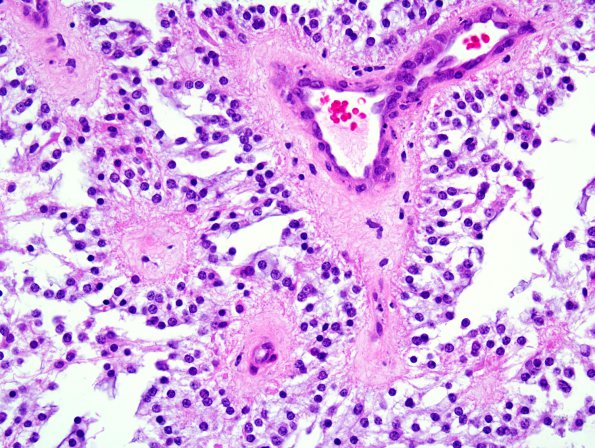 6B3 Astrocytoma, pilomyxoid & PA (Case 6) 4.jpg