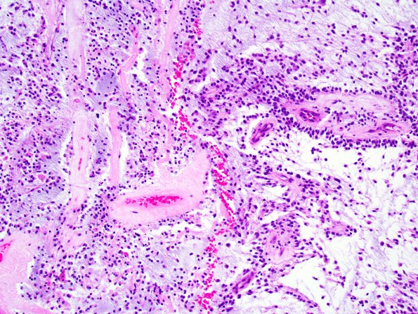 6B4 Astrocytoma, pilomyxoid & PA (Case 6) 7.jpg