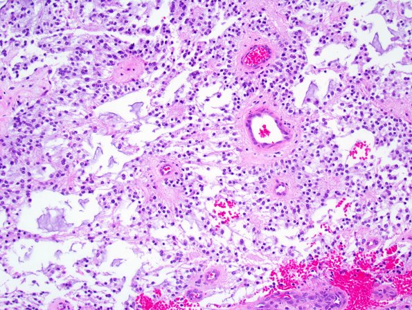 6B5 Astrocytoma, pilomyxoid & PA (Case 6) H&E 2.jpg