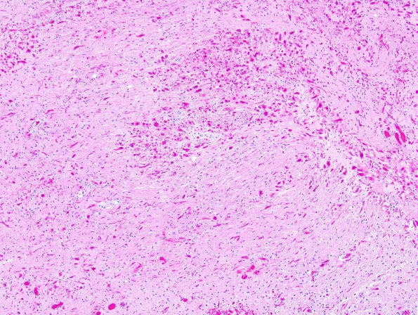 6B6 Astrocytoma, pilomyxoid & PA (Case 6) 5.jpg