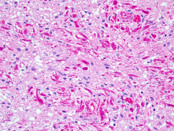 6B7 Astrocytoma, pilomyxoid & PA (Case 6) 8.jpg