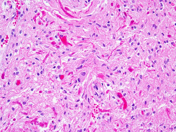 6B8 Astrocytoma, pilomyxoid & PA (Case 6) 6.jpg