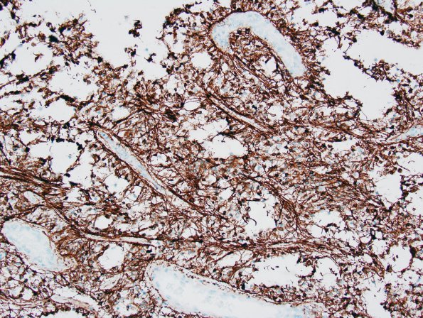 6C1 Astrocytoma, pilomyxoid & PA (Case 6) GFAP 1.jpg