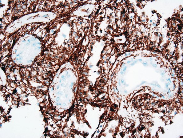 6C2 Astrocytoma, pilomyxoid & PA (Case 6) GFAP 2.jpg