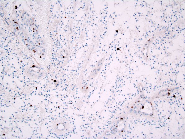 6D Astrocytoma, pilomyxoid & PA (Case 6) Ki-67 1.jpg