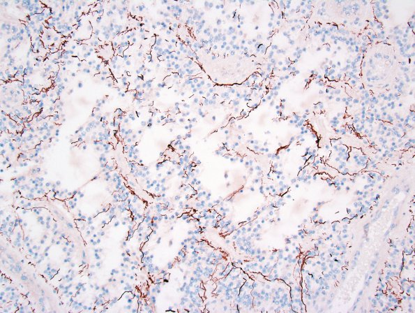 6E Astrocytoma, pilomyxoid & PA (Case 6) NFP 1.jpg