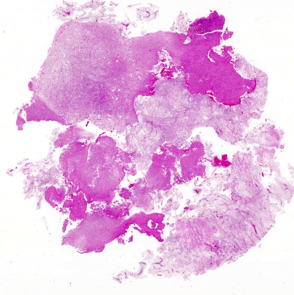 7A1 Astrocytoma, pilomyxoid (Case 7) H&E whole mount