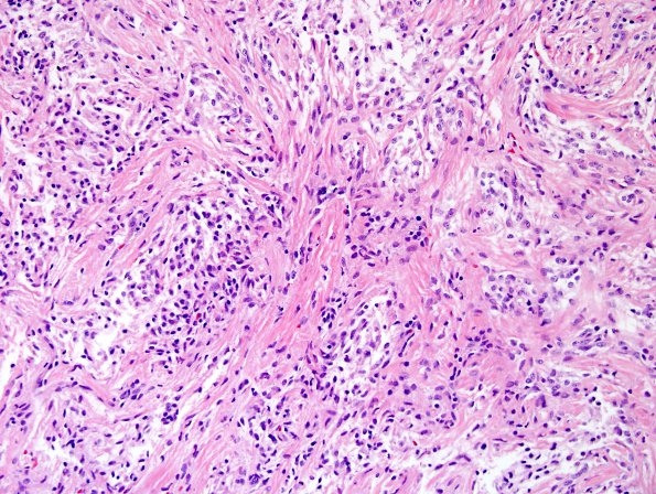 7A2 Astrocytoma, Pilomyxoid (Case 7) H&E 2 (2).jpg