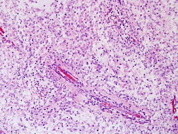 7A3 Astrocytoma, Pilomyxoid (Case 7) H&E 6 (2).jpg