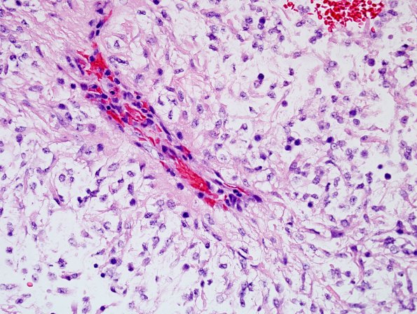 7A4 Astrocytoma, Pilomyxoid (Case 7) H&E 8 (2).jpg