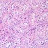 7A5 Astrocytoma, Pilomyxoid (Case 7) H&E 9 (2).jpg