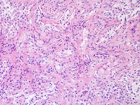 7A5 Astrocytoma, Pilomyxoid (Case 7) H&E 9 (2).jpg