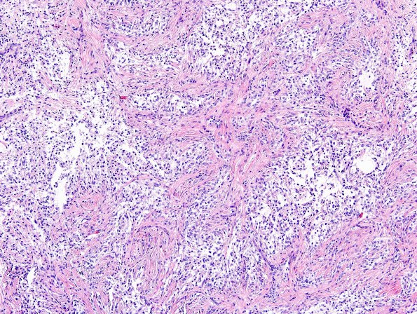 7A6 Astrocytoma, pilomyxoid (Case 7) H&E 18.jpg