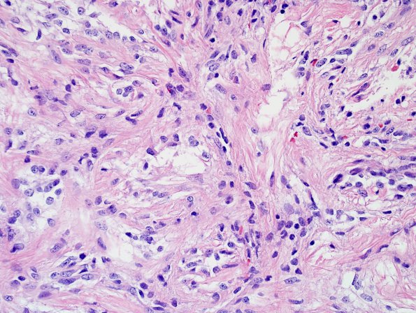 7A7 Astrocytoma, Pilomyxoid (Case 7) H&E 10 (2).jpg