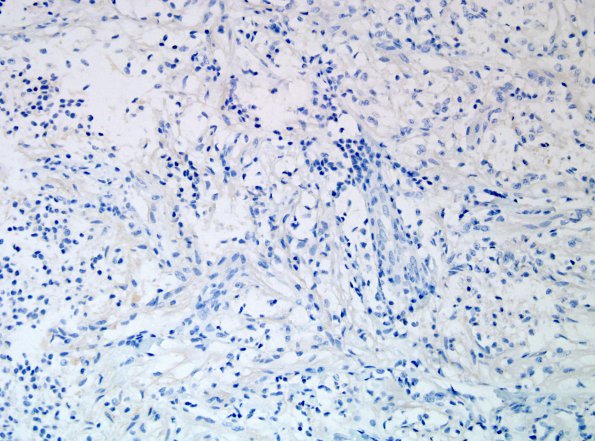 7C Astrocytoma, Pilomyxoid (Case 7) NF 1.jpg