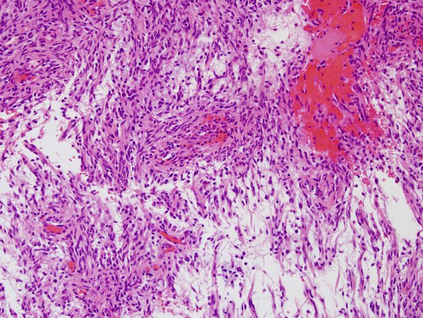 8B1 Astrocytoma, Pilomyxoid (Case 8) H&E 3.jpg