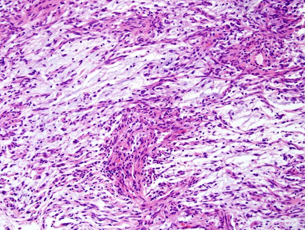 8B2 Astrocytoma, Pilomyxoid (Case 8) H&E 5.jpg