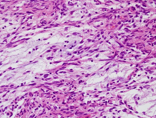 8B3 Astrocytoma, Pilomyxoid (Case 8) H&E 4.jpg