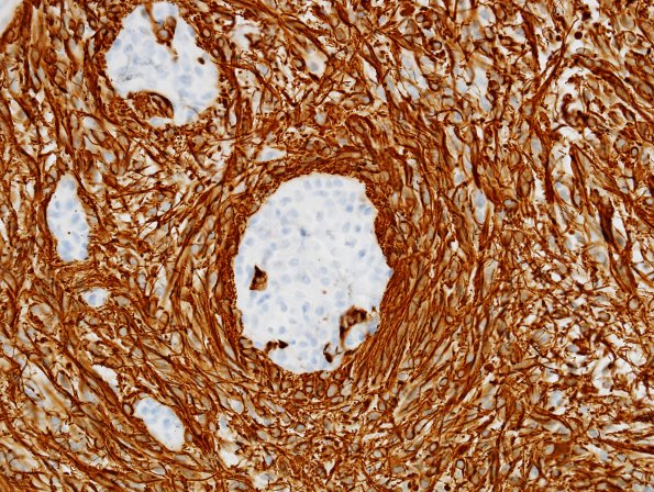 8C1 Astrocytoma, Pilomyxoid (Case 8) GFAP 2.jpg