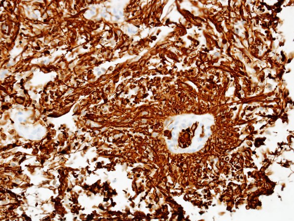 8C2 Astrocytoma, Pilomyxoid (Case 8) GFAP 1.jpg