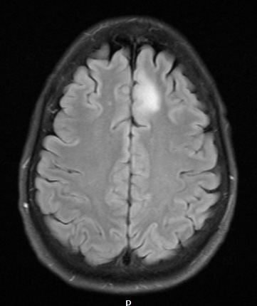 10A1 (Case 10) FLAIR - Copy